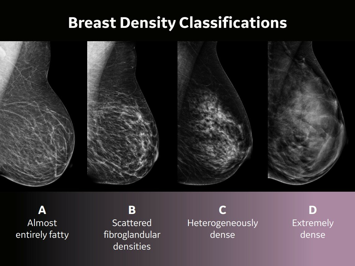 Breast density varies greatly among women, and Memorial Medical Center has added equipment for better quality mammograms.